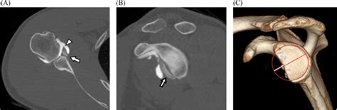 A 37 Year Old Woman With Anterior Glenoid Fracture After Anterior