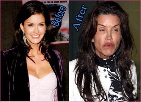 Top 25 Celebrities Before And After Plastic Surgery And Nose Jobs
