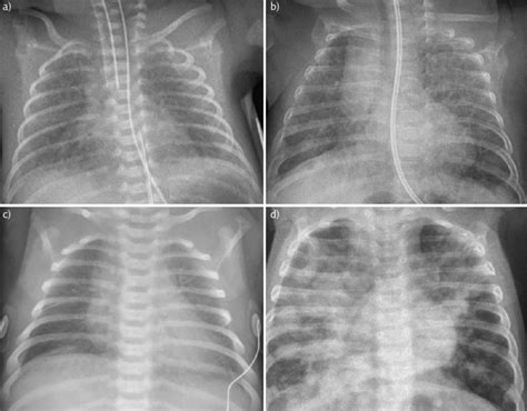 Chest Radiograph Images A Intubated 236 Weeks Preterm Infant With