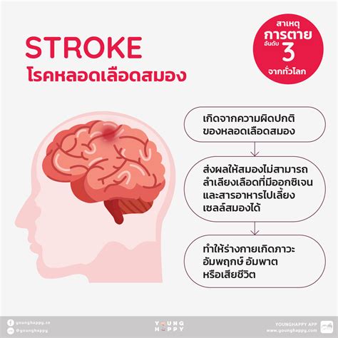 รู้ทัน Stroke โรคหลอดเลือดสมอง สาเหตุของการเป็นอัมพฤกษ์ อัมพาตในผู้สูงอายุ