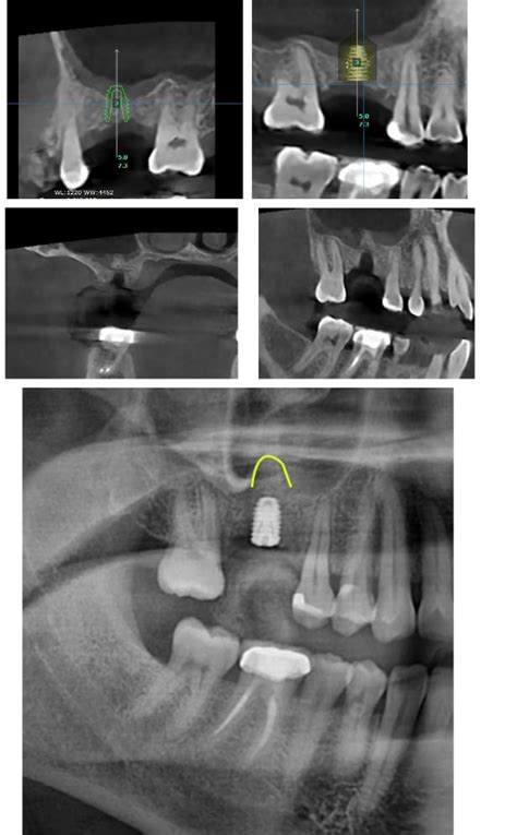 Implant With Sinus Bone Graft California Dentistry And Braces