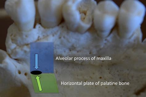 Junction Of The Alveolar Process Of The Maxilla And Horizontal Plate Of