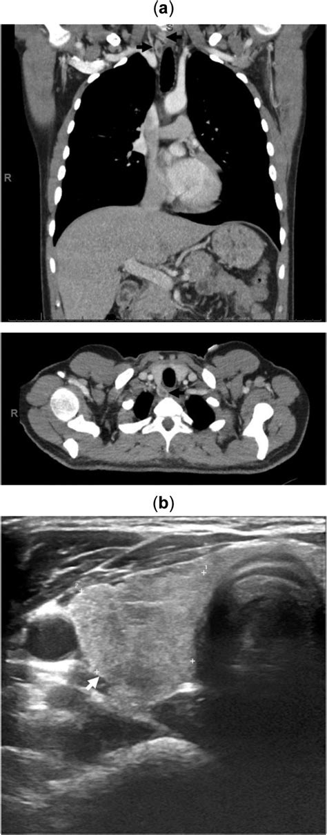 Two Parathyroid Adenomas Identified By Ct A And Ultrasound Scan B