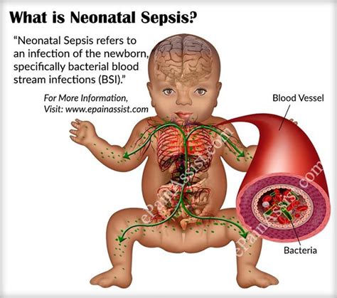 What Is Neonatal Sepsis Sepsis Neonatal Neonatal Nurse