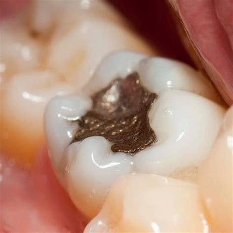 Dental Amalgams Are Really Safe Or Not