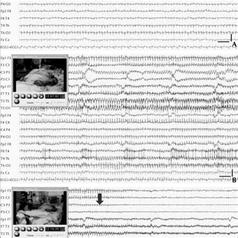 Pdf Stimulus Sensitive Post Anoxic Focal Motor Seizures Evolving Into