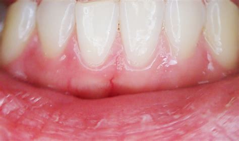 White Gum Infection