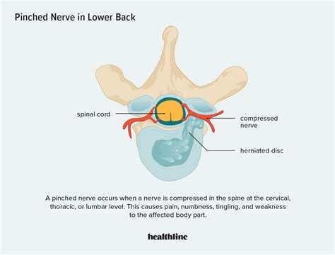 Pinched Nerve In Lower Back Causes Symptoms And Treatments Artofit