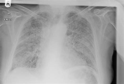 Cardiogenic Pulmonary Oedema Rcemlearning
