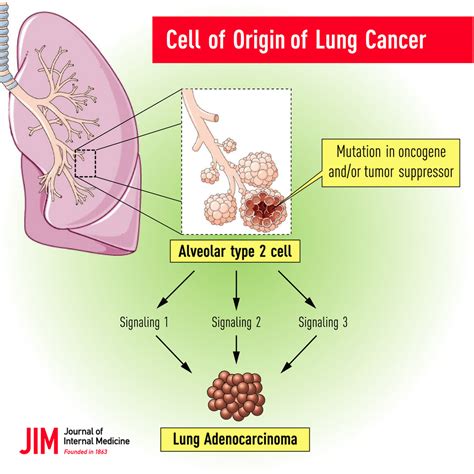 Lung Cancer Cells Diagram