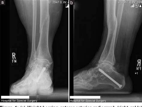 Figure 1 From Correction Of Tibial Malunion In A Patient With