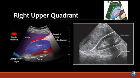 What Does Bladder Cancer Look Like On Ultrasound Updated