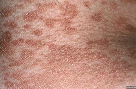 Skin Disease Types Tinea Versicolor