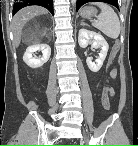Right Adrenal Myelolipoma Adrenal Case Studies Ctisus Ct Scanning
