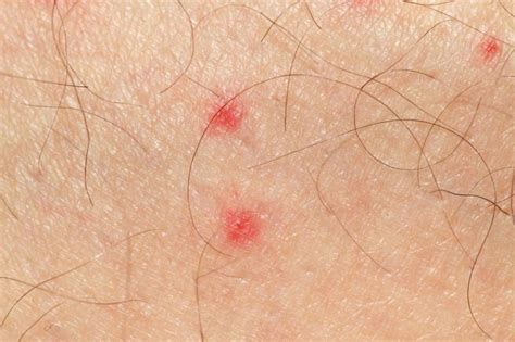 What Is Petechiae And What Are Its Causes