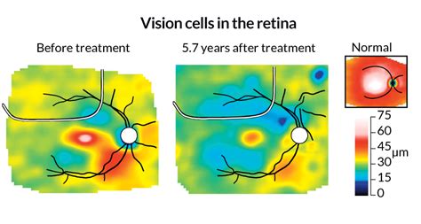 Gene Therapy For Blindness Dims A Bit