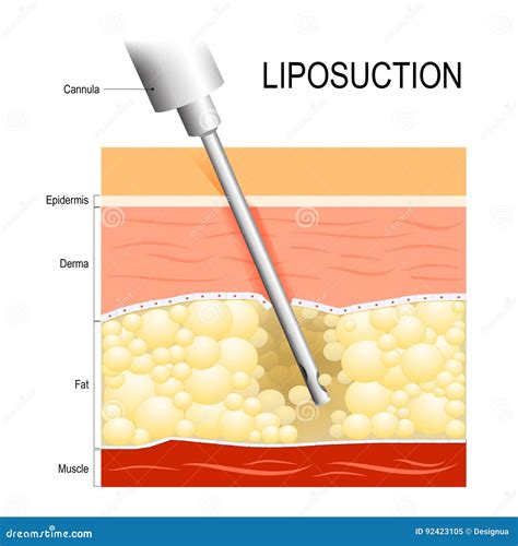 Liposuction Cannula Into The Fat Layer Beneath Skin Stock Vector