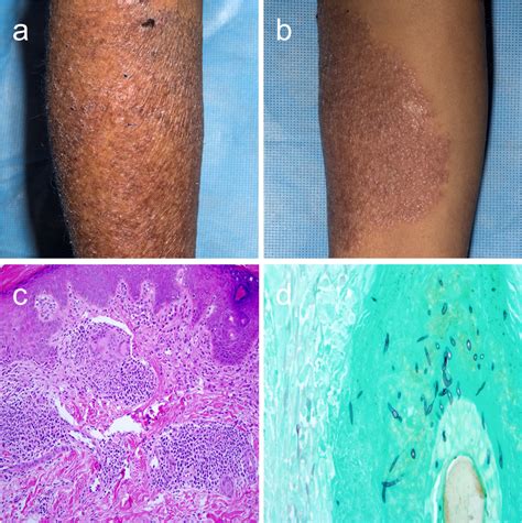 Clinical And Histopathologic Presentation Of Primary Invasive Cutaneous