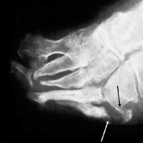 Advanced Stage Of Neuro Osteo Arthropathy Charcot Foot On