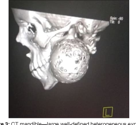 Figure 1 From A Large Aneurysmal Bone Cyst Of Mandible A Rare Case
