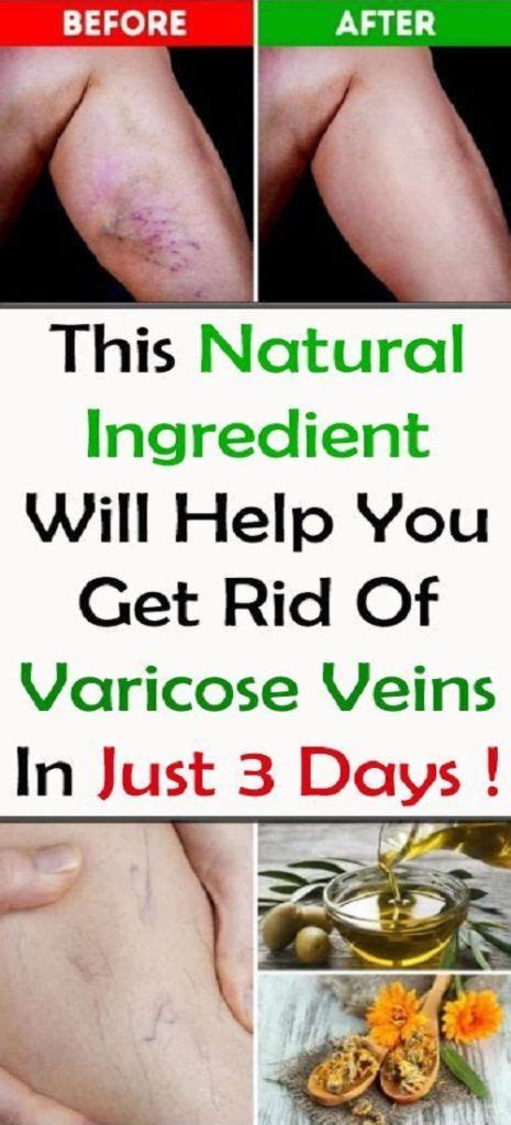 This Natural Ingredient Will Help You Get Rid Of Varicose Veins In Just
