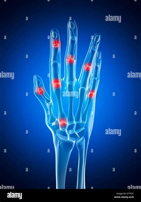 Human Hand Joints Showing Arthritis Computer Artwork Stock Photo Alamy
