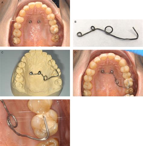 Maxillary Molar Intrusion Using Mini Implants In The Anterior Palate Mousetrap Versus Mini