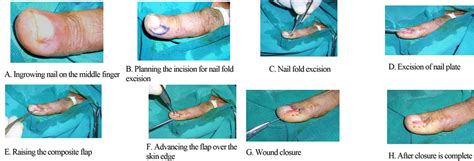Pincer Nail Surgery Nail Ftempo