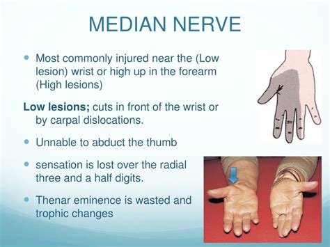 Paralysis Of Median Nerve