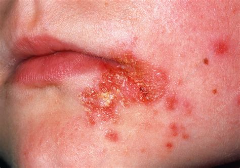 Impetigo Skin Infection Stock Image M1800096 Science Photo Library