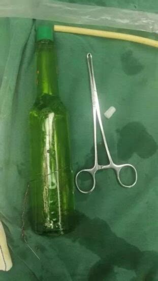 Man Has Seven Inch Glass Bottle Removed From Rectum After Using It To ‘scratch An Itch’ Rare