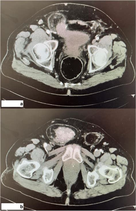 Axial Ct Scan With Contrast Showed Multifocal Polypoid Enhancing