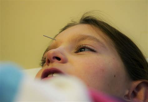 Treating Children With Acupuncture Aag
