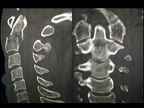 Cervical Spine Trauma Imaging