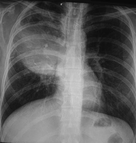 Radiographie thoracique de face opacité pulmonaire droite Download