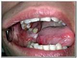 Insurance Cover Wisdom Teeth Removal Images