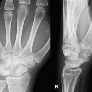 Occurrence In Of Lunate Type II With Individual Ulnar Bone Variants Download Scientific