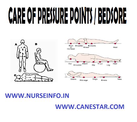 Care Of Pressure Ponts Bed Sore Nurse Info