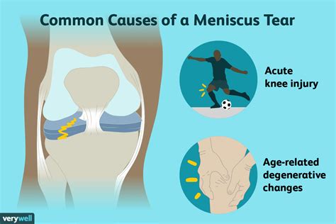 A Torn Meniscus Often Can Be Identified By Sports Medicine