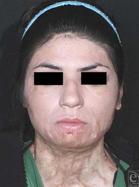 Figure 4 Preoperative Frontal View Open I