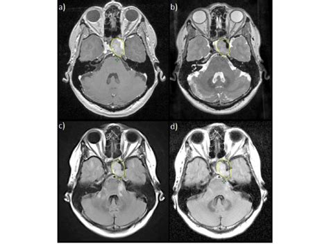 delineation of the pituitary macroadenoma on a 3d t1 download scientific diagram