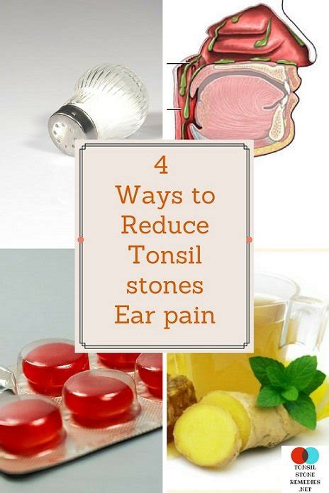 4 Ways To Reduce Tonsil Stones Ear Painclogged Ears