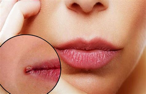 12 Home Remedies To Heal Cracked Lip Corners Fast That Really Work