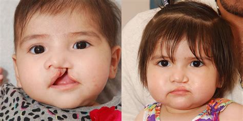 Cleft Lip Surgery Before And After