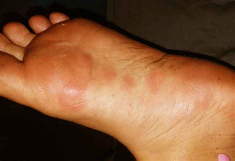 Ringworm On Foot Pictures Causes And Treatment
