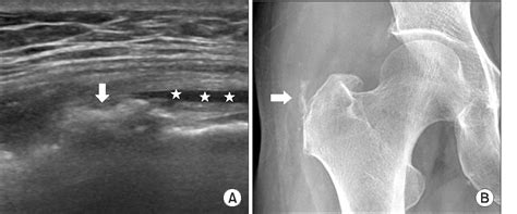Figure From Calcific Tendinopathy Of The Gluteus Medius Mimicking