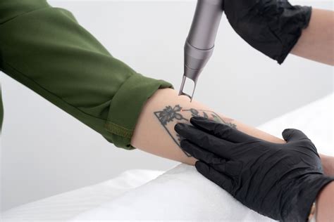 Details 96 About Different Types Of Laser Tattoo Removal Super Cool Indaotaonec