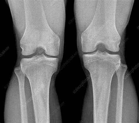 Normal Knees X Ray Stock Image F0033510 Science Photo Library