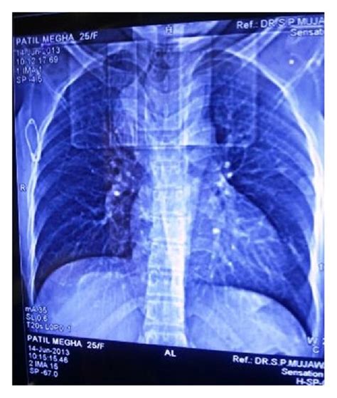 Chest X Ray Showing Opacity Along Right Paratracheal Region Download