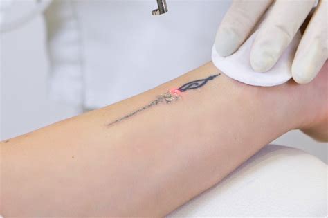 Vakuum J Hrlich Bez Glich Laser Clinic Tattoo Removal Bachelor